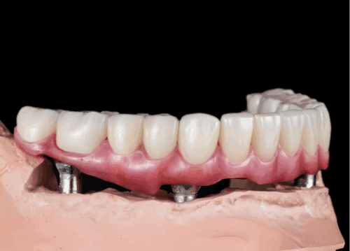 All-on-4 dental implantların çene kemiğine yerleştirilmesini ve tam bir protezi desteklemesini gösteren 3D medikal illüstrasyon