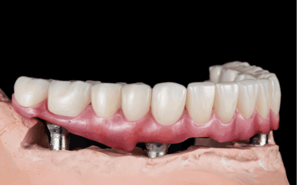 3D medical illustration showing the placement of All-on-4 dental implants in the jawbone and supporting a complete denture