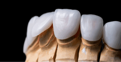 Ceramic dental crown treatment, appearance of the teeth on the model
