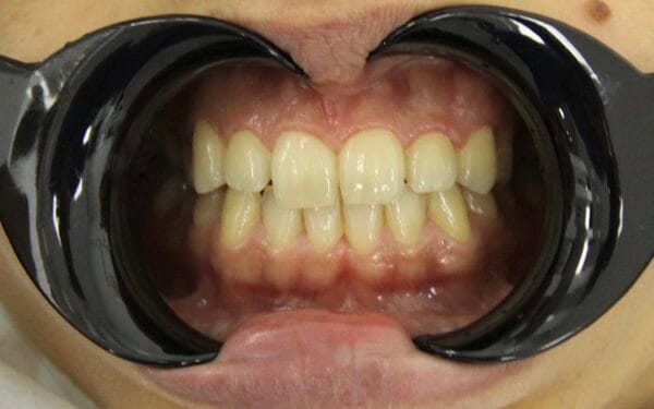 Patient before smile makeover treatment at AuraDent Clinic, Cyprus
