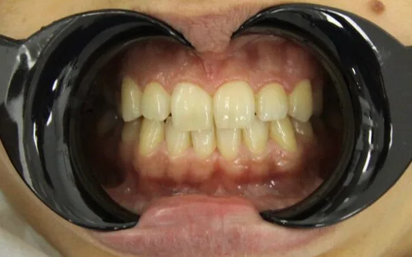 Patient before smile makeover treatment at AuraDent Clinic, Cyprus