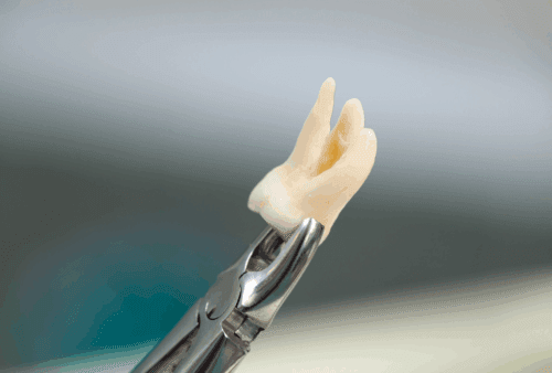 Dental equipment holding an extracted tooth (wisdom tooth)