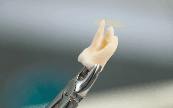 Dental equipment holding an extracted tooth (wisdom tooth)