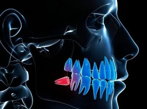 Alt çenede gömülü yirmilik dişi gösteren 3D diş illüstrasyonu