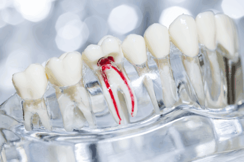 Dental illustration showing root canals of the tooth.