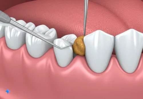 image shows food impaction between healthy tooth