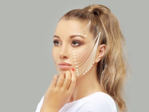 AuraDent Estetik Klinik, Kıbrıs'ta resimde gösterilen yüzdeki kaldırma noktalarını kullanarak örümcek ağı yüz kaldırma uygulaması yapılmaktadır