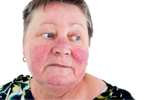 Symptoms of rosacea are clearly visible on the patient's face