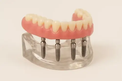 3D medical illustration showing the placement of All-on-4 dental implants in the jawbone and supporting a complete denture
