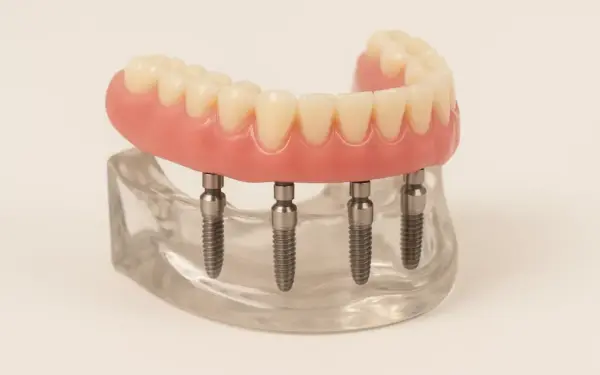 3D medical illustration showing the placement of All-on-4 dental implants in the jawbone and supporting a complete denture