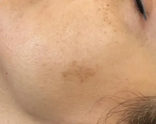 Our female patient has spotting on her face. Melasma treatment at AuraDent