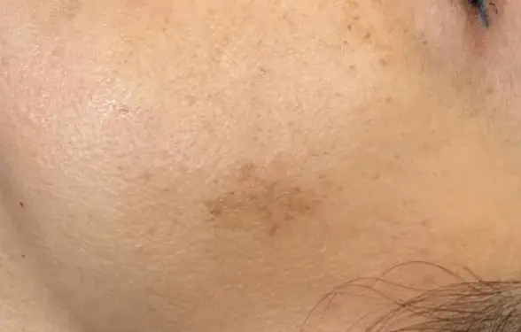 Our female patient has spotting on her face. Melasma treatment at AuraDent