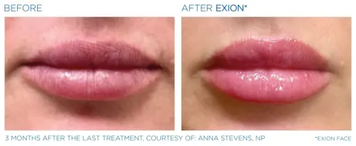 The picture shows before and after lip rejuvenation & augmentation with BTL Exion Face. With the privilege of AuraDent, Cyprus, this needle-free and painless procedure is now at your side.