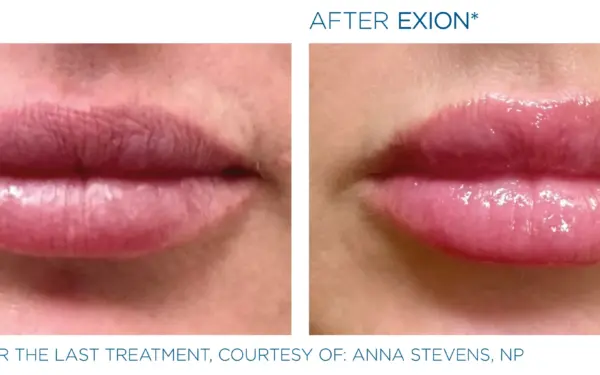 The picture shows before and after lip rejuvenation & augmentation with BTL Exion Face. With the privilege of AuraDent, Cyprus, this needle-free and painless procedure is now at your side.