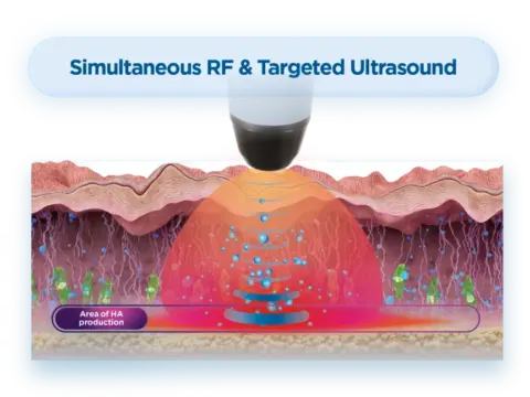 Satin Face Lifting with Simultaneous RF and Targeted Ultrasound – advanced non-surgical facelift for skin tightening, wrinkle reduction, collagen and HA stimulation, and facial rejuvenation.