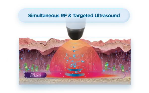 Satin Face Lifting with Simultaneous RF and Targeted Ultrasound – advanced non-surgical facelift for skin tightening, wrinkle reduction, collagen and HA stimulation, and facial rejuvenation.