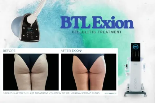 Cellulite treatment with AuraDent in TRNC: The BTL Exion device burns fat, tightens the skin and helps skin regeneration by increasing collagen production.