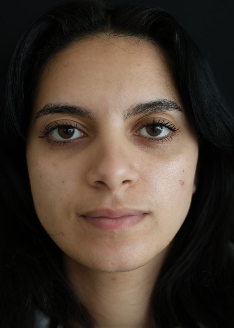 Photo taken just before the lip filler treatment