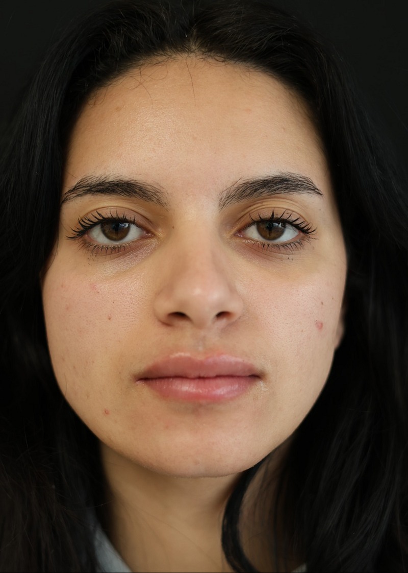 Before and after photo of lip fillers at AuraDent