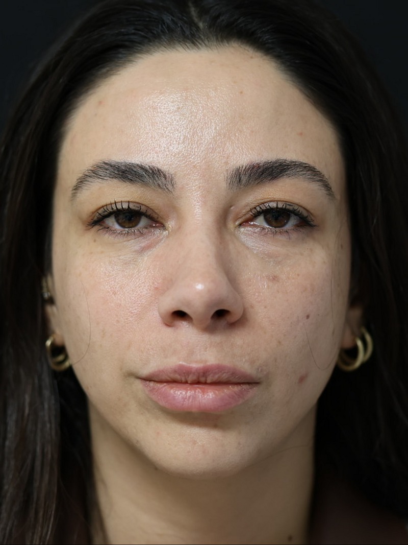 AuraDent yüz oranınıza uygun doğal dudak dolgusu