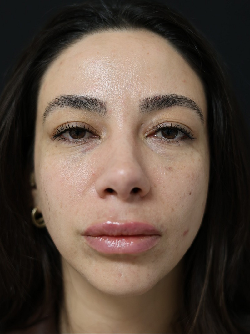 Natural lip fillers at AuraDent