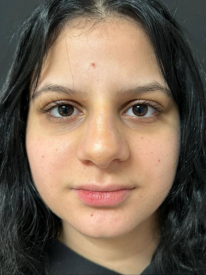 Before the lip fillers