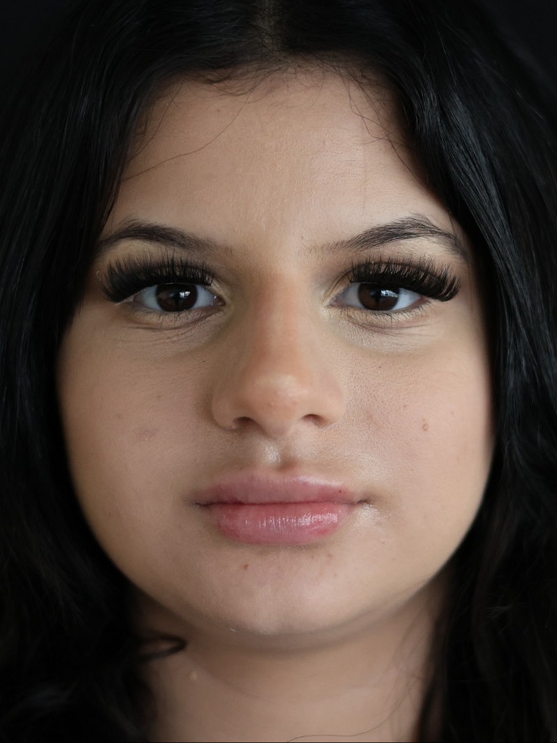 After the lip fillers treatment