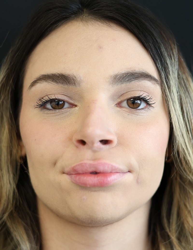our patient just after lip fillers treatment