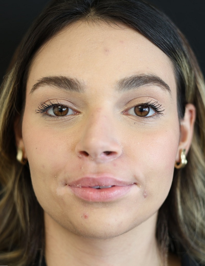 our patient before the lip fillers treatment