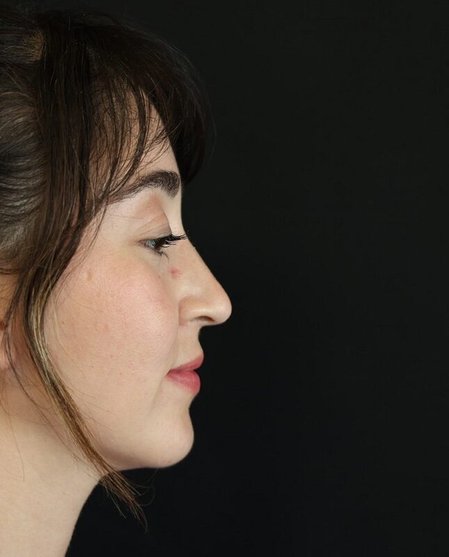 Before the nose filler treatment