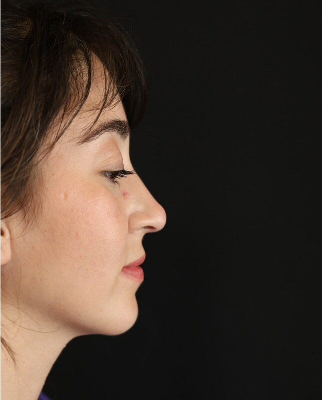 after the nose filler operation