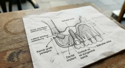 Bu resim, lateral pencere sinüs kaldırma olarak bilinen cerrahi prosedürü ve ardından yapılan diş implantı yerleştirme işlemini gösteren ayrıntılı bir şemadır. Bu şema, AuraDent'te gerçekleştirilen prosedürü göstermektedir.